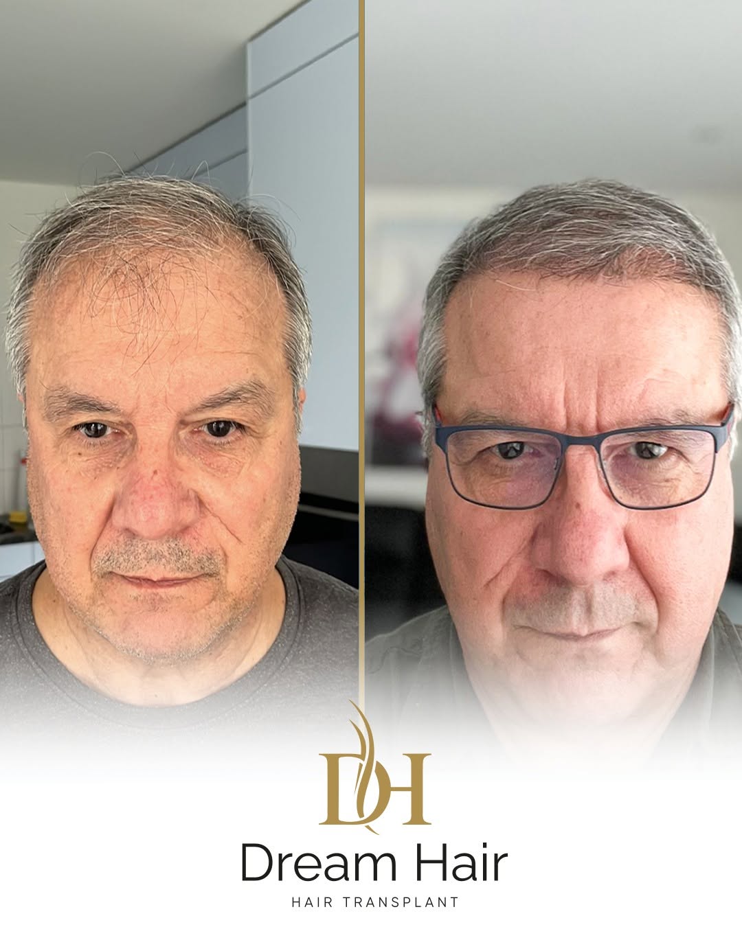 DreamHair — rezultat transplantacije kose