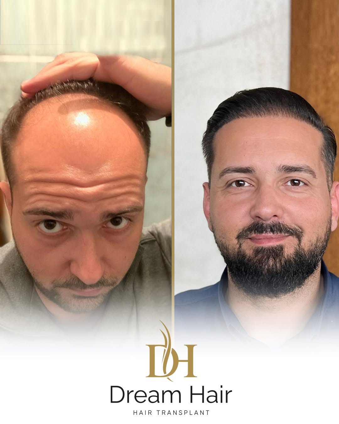 DreamHair — rezultat transplantacije kose
