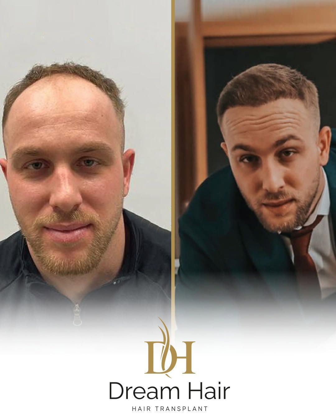 DreamHair — rezultat transplantacije kose
